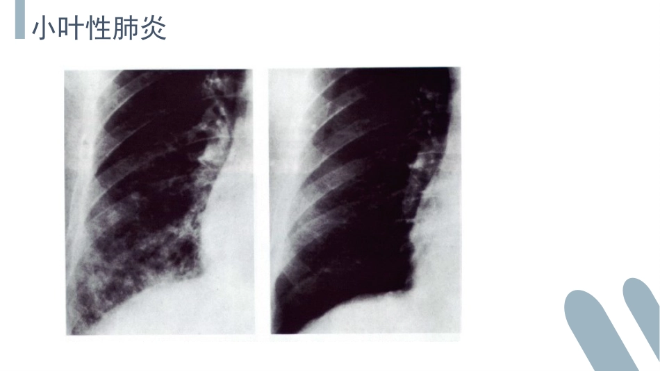 肺部感染介绍_第13页