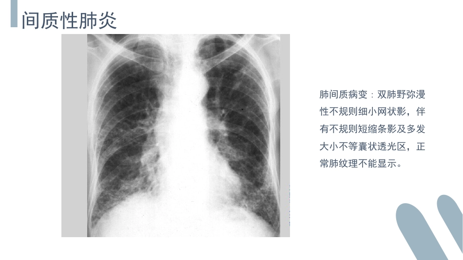 肺部感染介绍_第14页