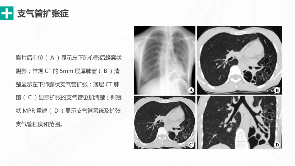 肺部感染性疾病的影像观察与分析_第10页
