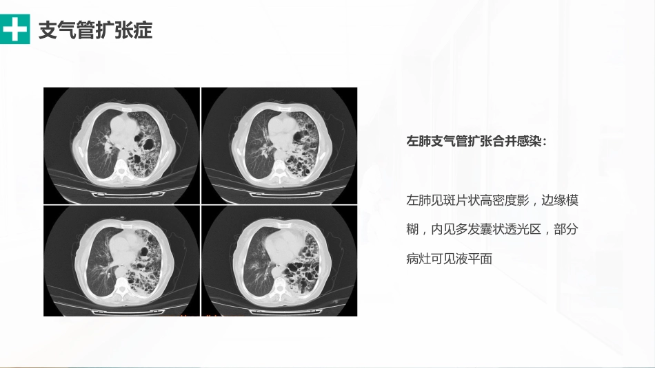 肺部感染性疾病的影像观察与分析_第11页
