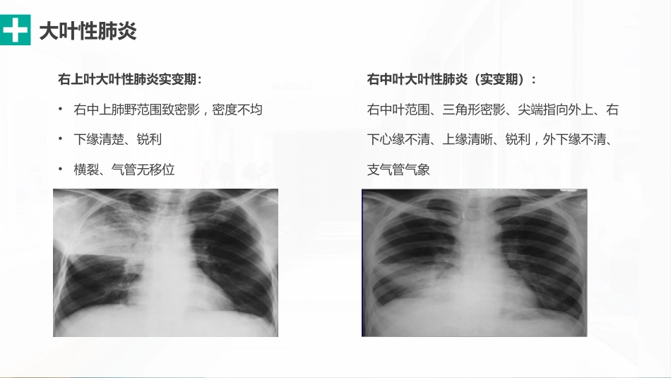 肺部感染性疾病的影像观察与分析_第15页