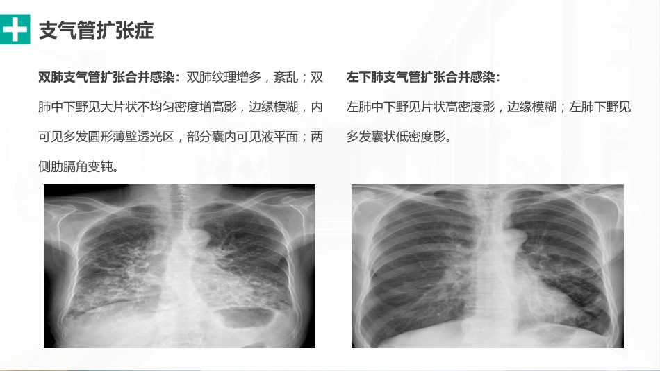 肺部感染性疾病的影像观察与分析_第5页