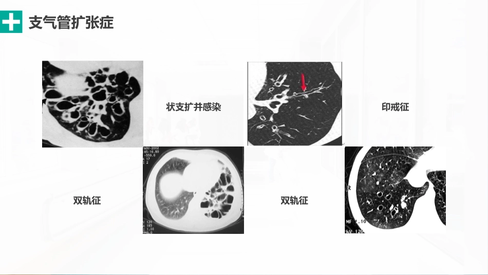 肺部感染性疾病的影像观察与分析_第9页