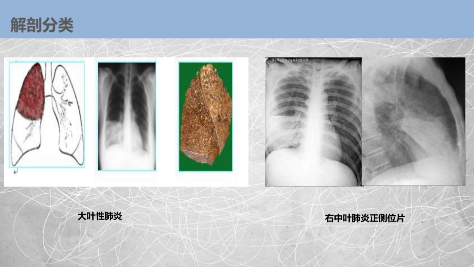 肺部感染性疾病2_第13页