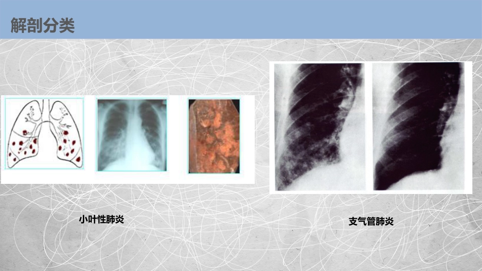 肺部感染性疾病2_第14页