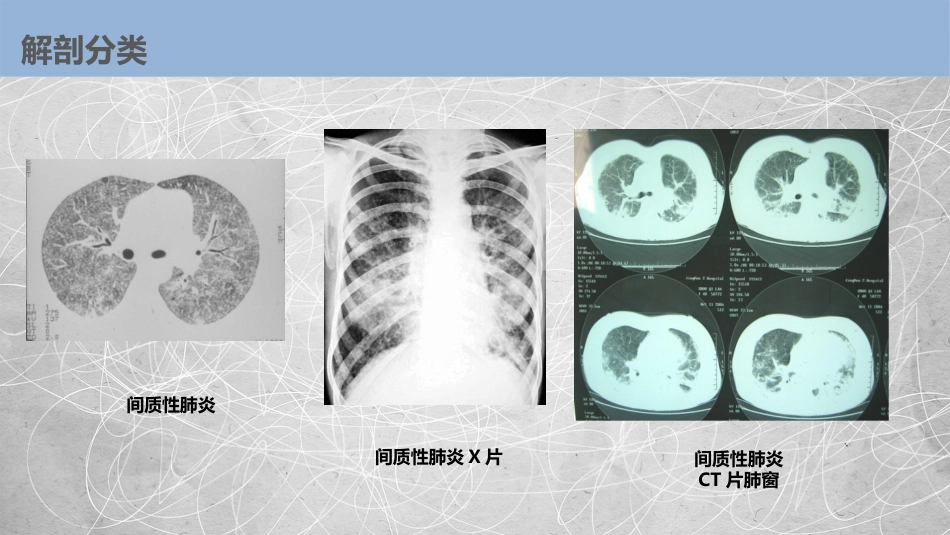 肺部感染性疾病2_第15页