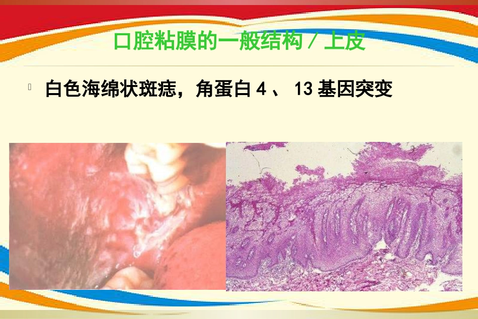 《口腔黏膜病》PPT课件_第11页