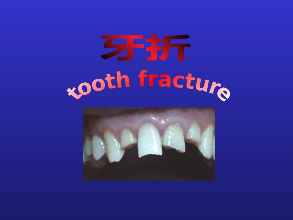 【口腔医学】牙折的病因及治疗方法PPT_第1页