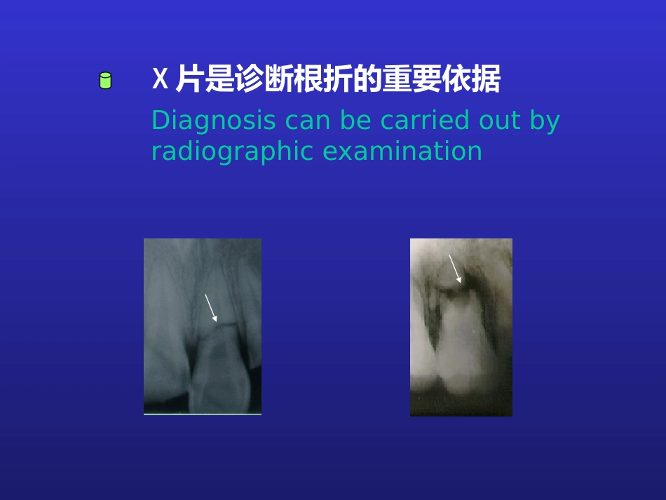 【口腔医学】牙折的病因及治疗方法PPT_第11页