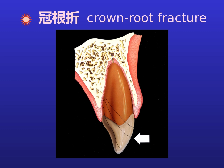 【口腔医学】牙折的病因及治疗方法PPT_第12页