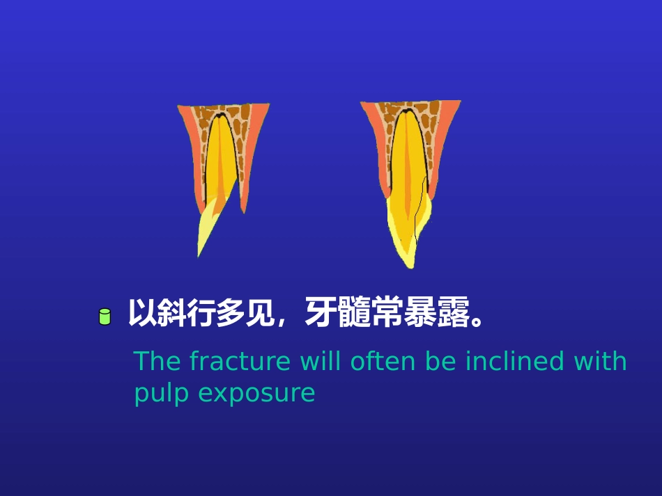 【口腔医学】牙折的病因及治疗方法PPT_第13页