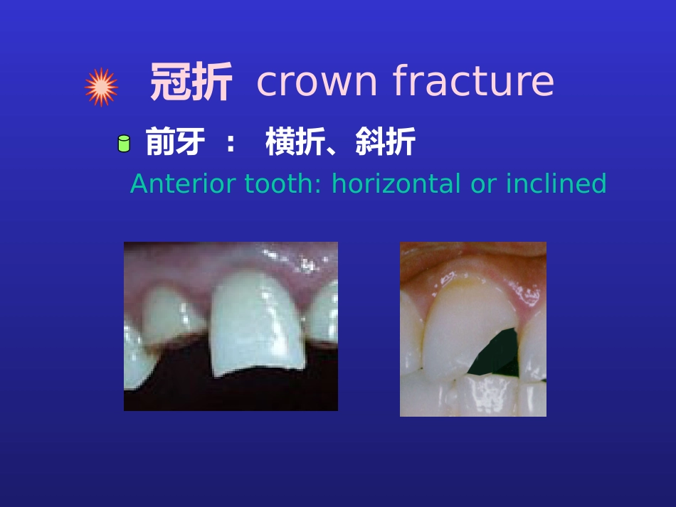 【口腔医学】牙折的病因及治疗方法PPT_第5页