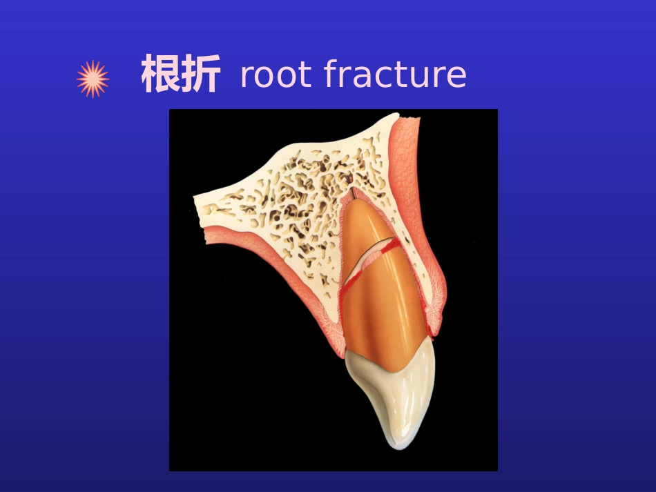 【口腔医学】牙折的病因及治疗方法PPT_第7页
