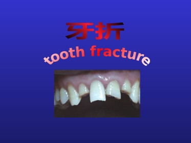 【口腔医学】牙折的病因及治疗方法PPT