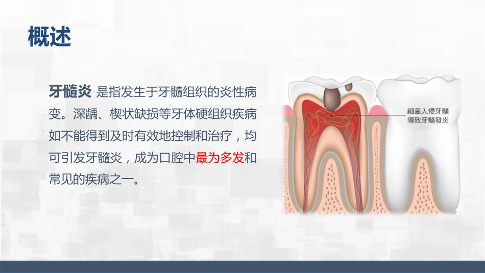 牙髓炎护理查房_第4页