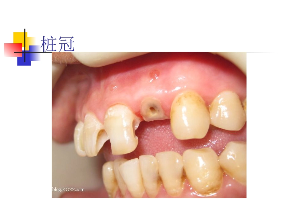拔牙_第6页