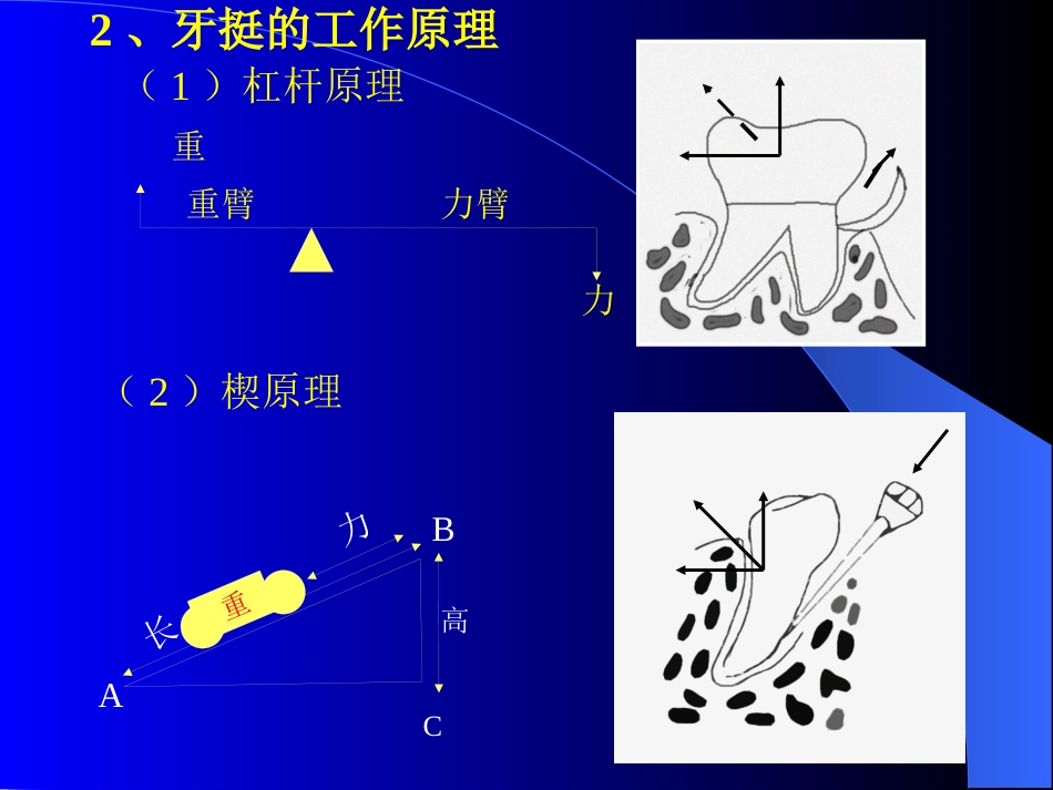 拔牙术及牙槽外科讲解_第15页
