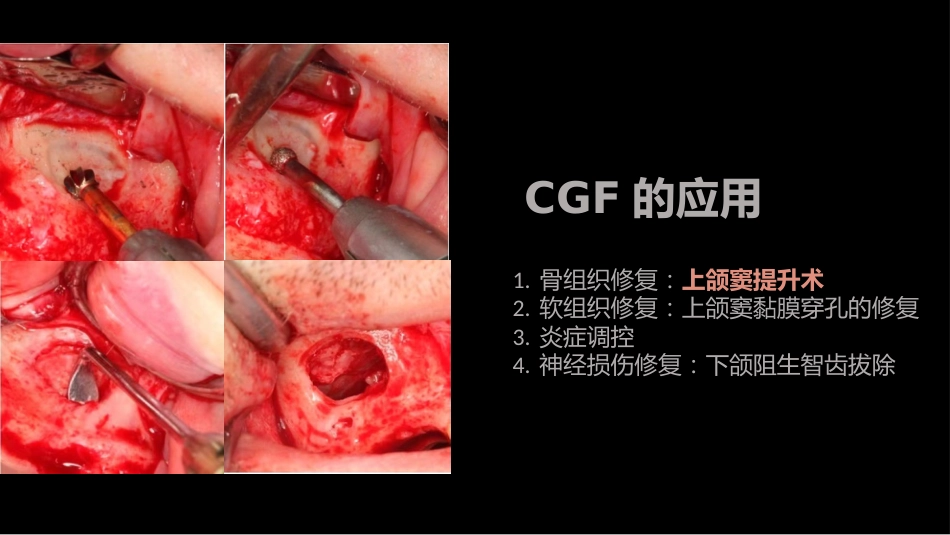 CGF在口腔修复中的应用_第6页