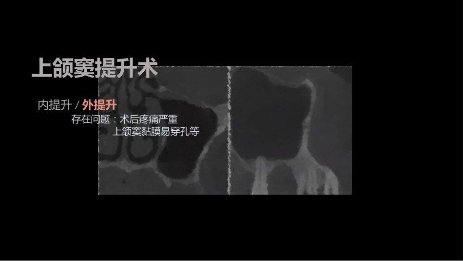 CGF在口腔修复中的应用_第7页