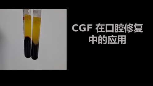 CGF在口腔修复中的应用