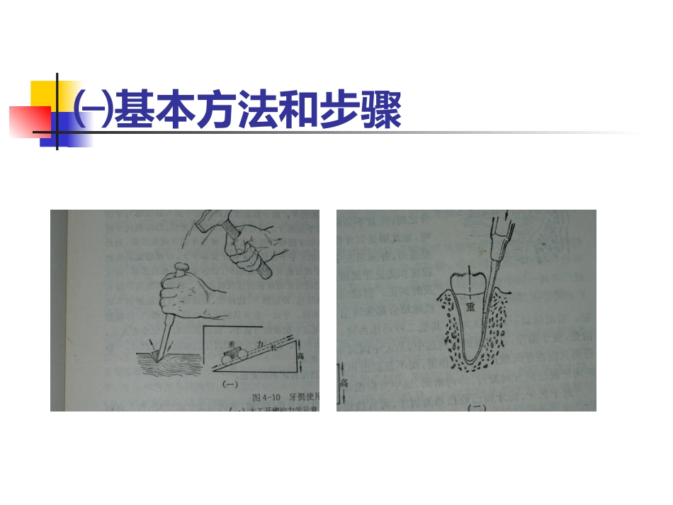 拔牙术_第10页