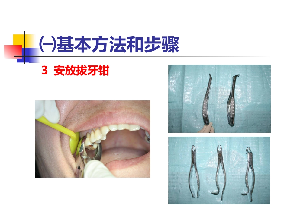 拔牙术_第13页
