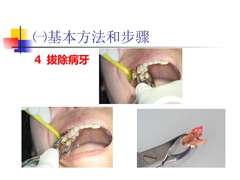 拔牙术_第15页