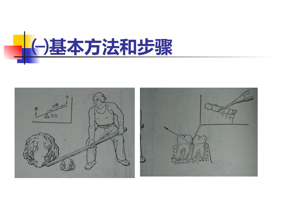 拔牙术_第8页