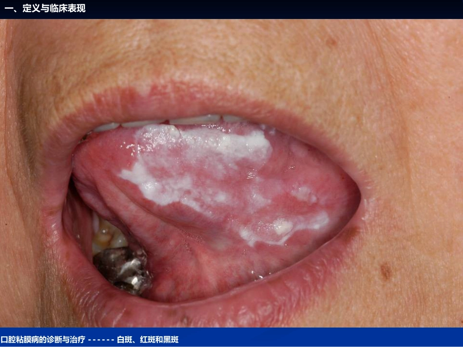 《口腔黏膜病学》课件口腔粘膜病的诊断与治疗_第10页