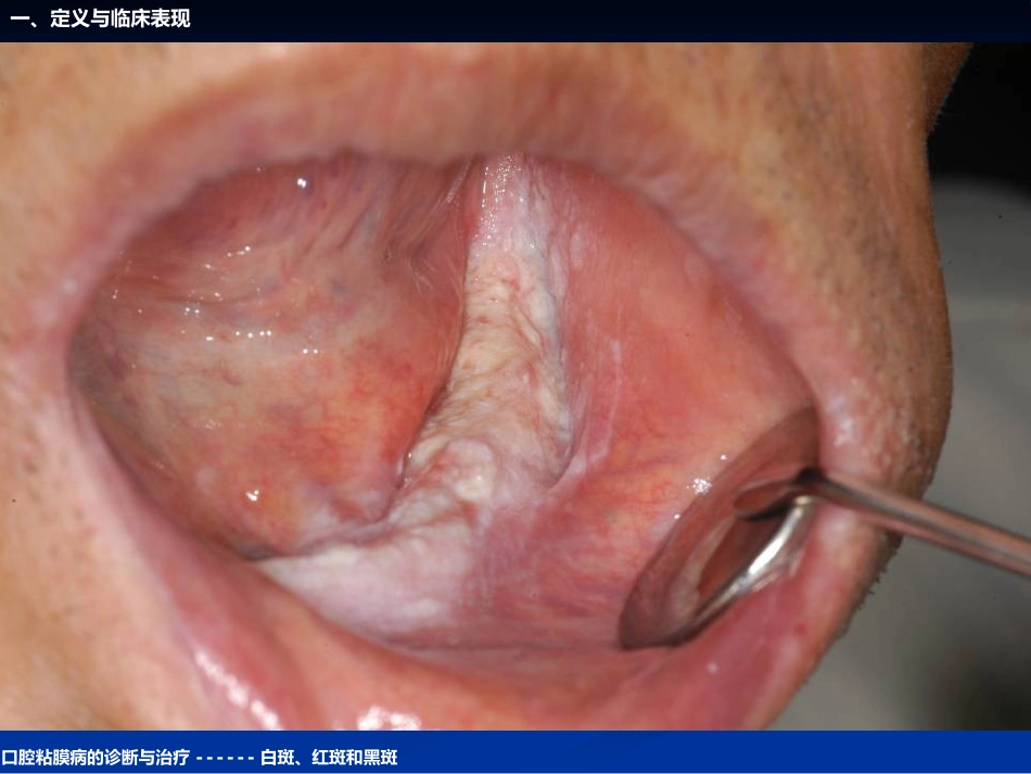 《口腔黏膜病学》课件口腔粘膜病的诊断与治疗_第11页