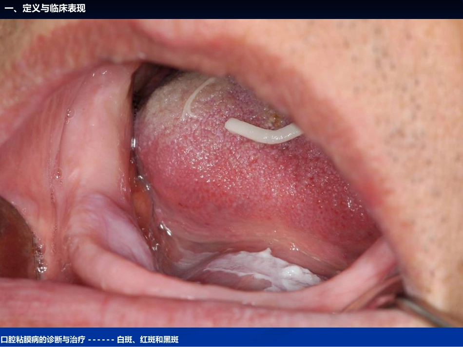《口腔黏膜病学》课件口腔粘膜病的诊断与治疗_第12页