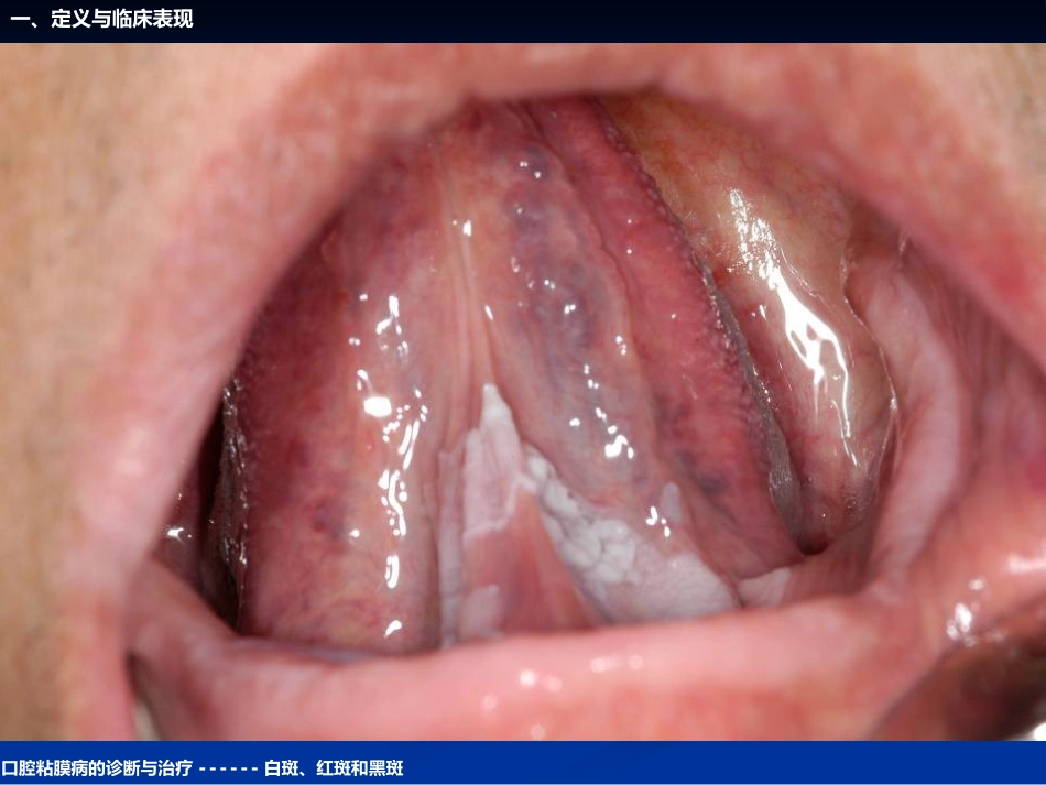 《口腔黏膜病学》课件口腔粘膜病的诊断与治疗_第13页