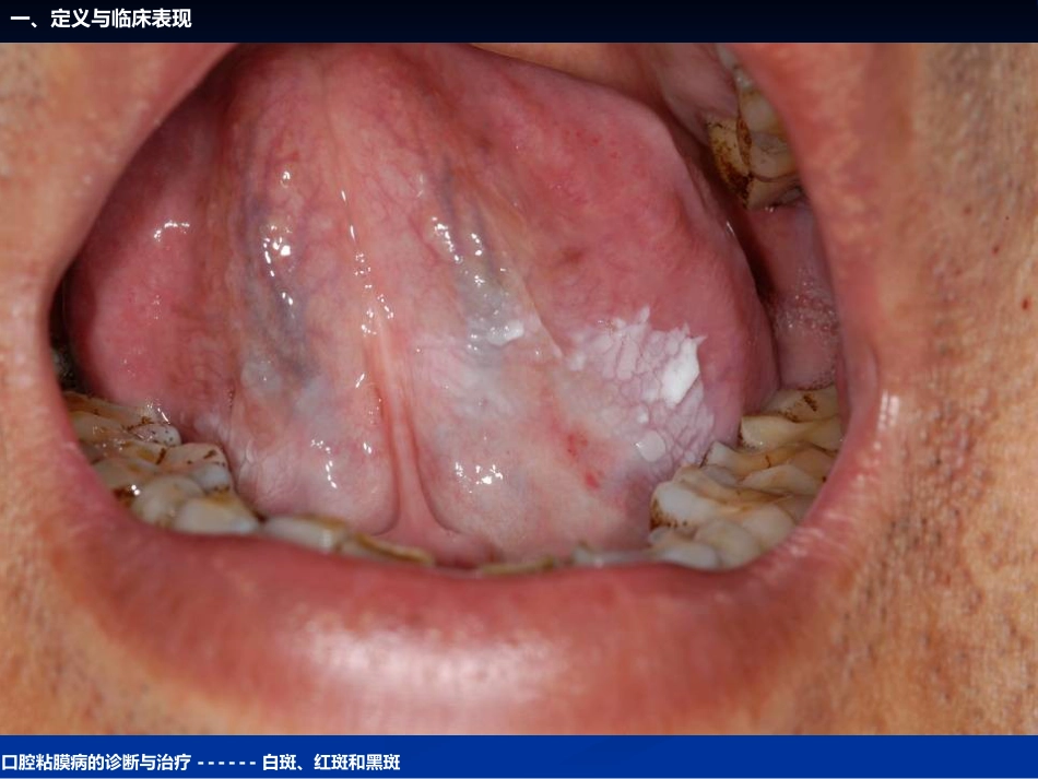 《口腔黏膜病学》课件口腔粘膜病的诊断与治疗_第14页