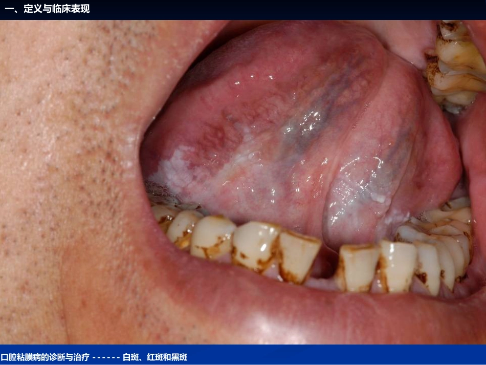 《口腔黏膜病学》课件口腔粘膜病的诊断与治疗_第15页