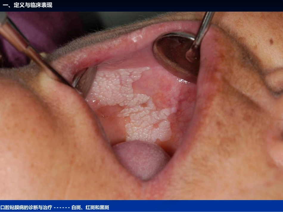 《口腔黏膜病学》课件口腔粘膜病的诊断与治疗_第6页