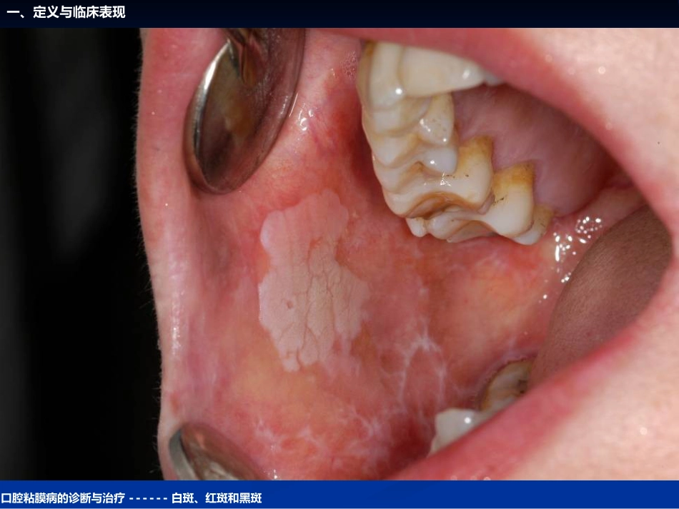 《口腔黏膜病学》课件口腔粘膜病的诊断与治疗_第7页
