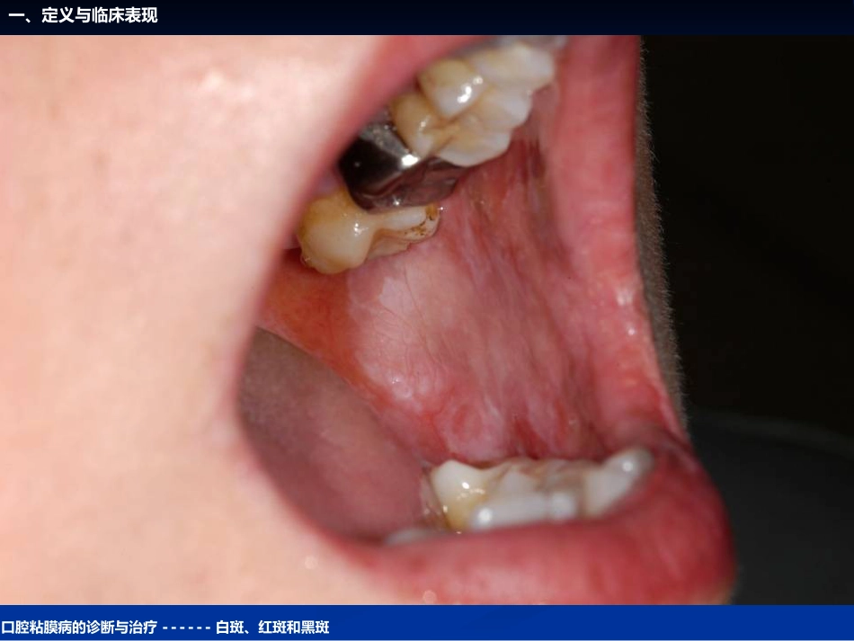 《口腔黏膜病学》课件口腔粘膜病的诊断与治疗_第8页