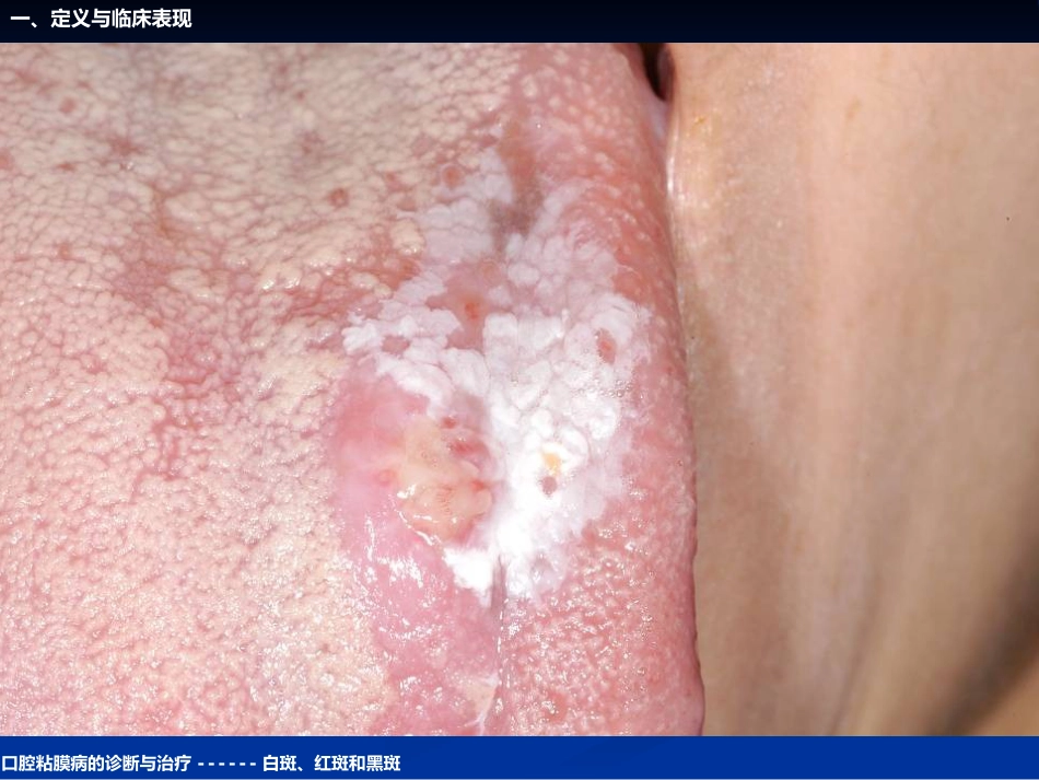 《口腔黏膜病学》课件口腔粘膜病的诊断与治疗_第9页