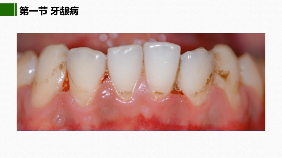 2020年高校课件口腔医学牙周疾病_第14页