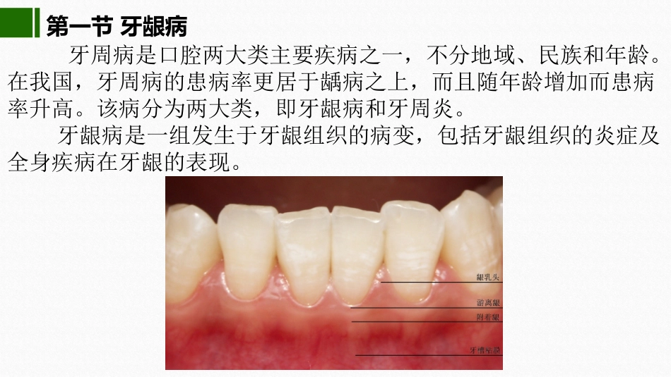 2020年高校课件口腔医学牙周疾病_第2页