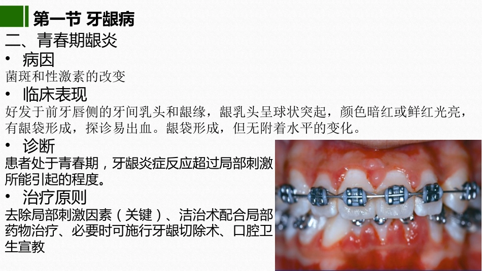 2020年高校课件口腔医学牙周疾病_第6页