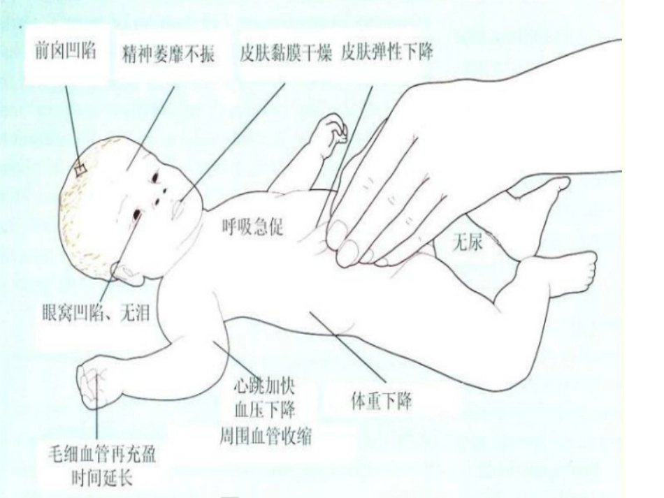 轮状病毒性肠炎 ppt课件【52页】_第13页