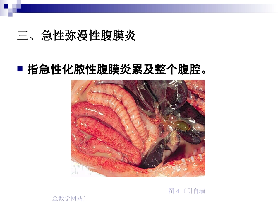 普外科-急性化脓性腹膜炎_第12页