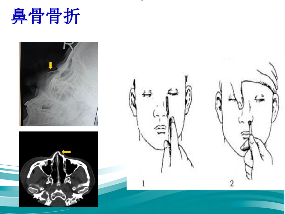 鼻的应用解剖及生理PPT课件_第6页