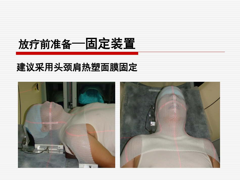 鼻咽癌IMRT靶区及剂量设计指引（专家共识）_第13页