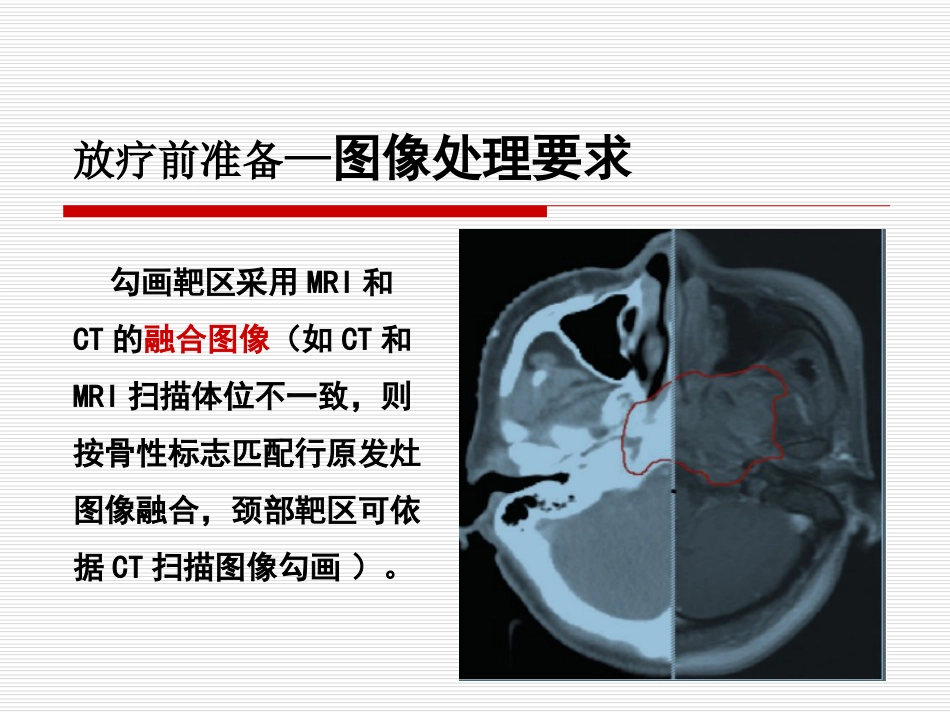 鼻咽癌IMRT靶区及剂量设计指引（专家共识）_第15页