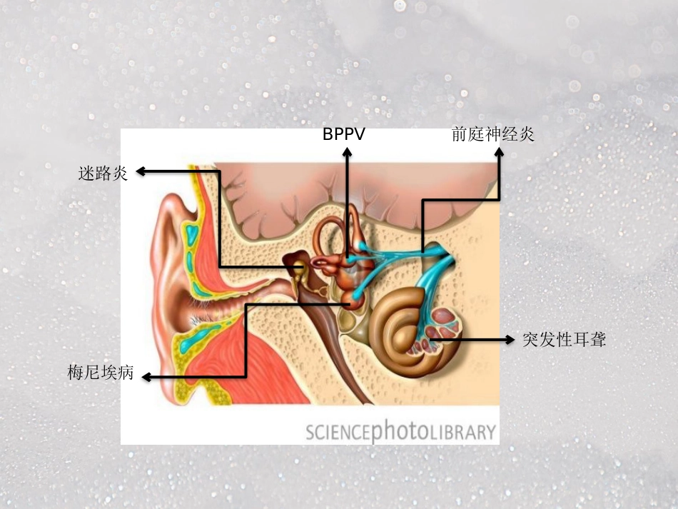 常见耳源性眩晕ppt课件_第5页