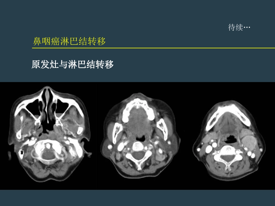 鼻咽癌放射治疗ppt_第14页