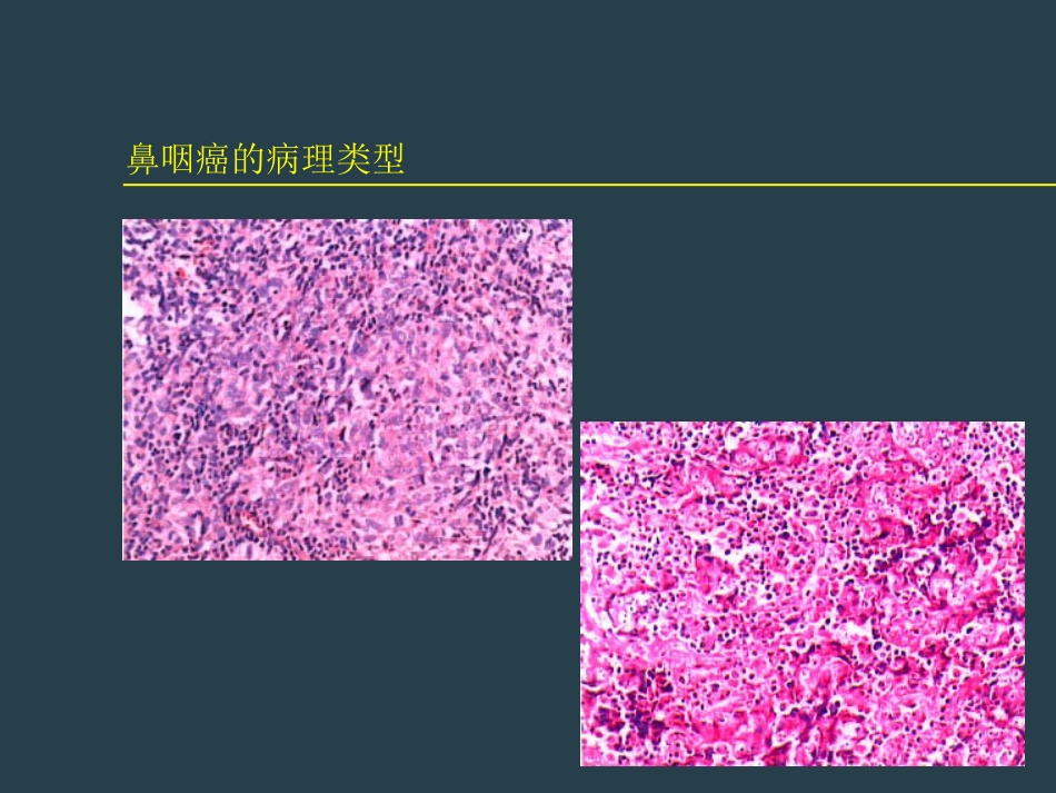 鼻咽癌放射治疗ppt_第6页