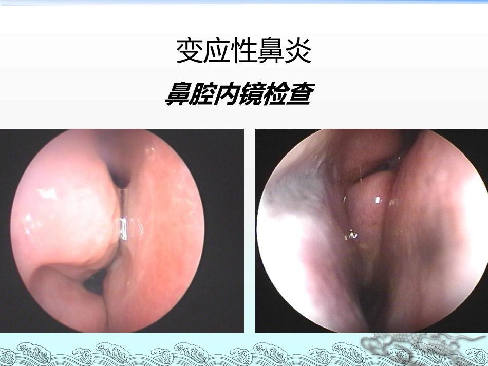 儿童变应性鼻炎的治疗护理及其新进展_第13页